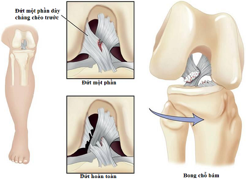 Đứt Dây Chằng Chéo Trước